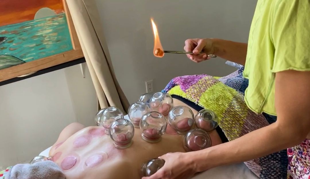 Cupping therapy